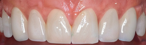 Hollywood tooth style