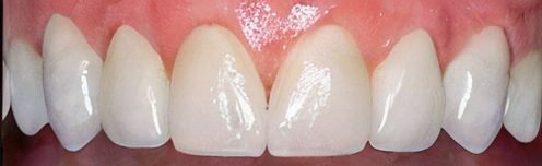Natural tooth style
